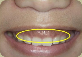【治療前】牙齦又黑又厚微笑就會露出很多牙肉不美觀
